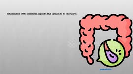 Appendicitis Signs & Symptoms - What Are The Most Common Signs & Symptoms Of Appendicitis