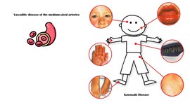 Kawasaki Disease - Signs & Symptoms |What Are The Major Signs & Symptoms Of Kawasaki Disease