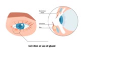 How To Get Rid Of A Stye At Home |Natural Remedies For Stye |Best Ways To Get Rid Of A Stye Easily