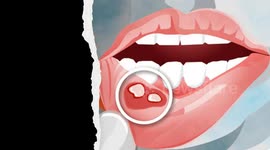How To Relieve Mouth Ulcers Naturally And Effectively |Natural Remedies For Mouth Ulcers/Canker Sore