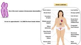 Turner Syndrome - Causes, Clinical Features, Diagnosis & Evaluation