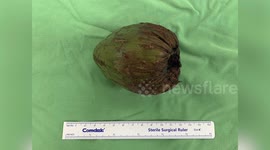 Doctors remove COCONUT stuck up man's bottom in Taiwan