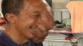 36-year-old has giant tumours growing on his face