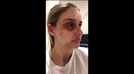 'My face was on fire and I wanted to rip my skin apart – I wouldn't wish this on anyone'