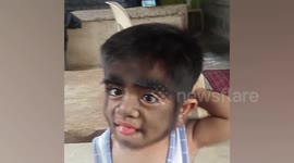Boy, 2, has one-in-a-billion werewolf syndrome after mum 'ate wild cat during pregnancy'