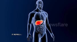 Five Signs Of Liver Cirrhosis That You Shouldn't Ignore |Signs & Symptoms Of Liver Cirrhosis