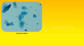 Bacterial Vaginosis - Causes, Risk Factors, Signs & Symptoms, Diagnosis, And Treatment