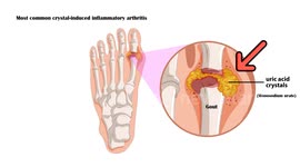 Gout Diet - Best And Worst Foods For Gout |What You Should Eat When You Have Gout & What To Avoid