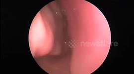 The doctor removed an 18cm long leech from an 8-year-old boy's nose