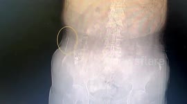 Chinese woman suffer from abdominal pain after having long sewing needle in her stomach
