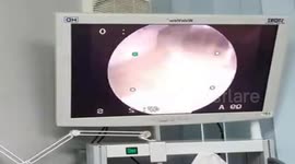 Doctor carefully removes cotton wool stuck in patient's ear canal