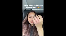Young woman documents her 'severe' allergic reaction after visiting nail salon