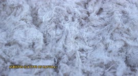Asbestosis - Causes, Pathogenesis, Signs & Symptoms, Diagnosis, And Treatment