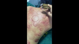 Woman uses smoke and fire to treat patients' back pain