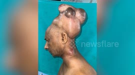 Doctors remove 6.8kg tumour sprouting from man's head in India
