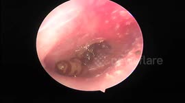 Vietnamese doctor removes HUGE poisonous ant from patient's ear