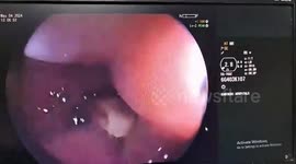 Doctors remove mutton bone that was lodged in man's throat for a month
