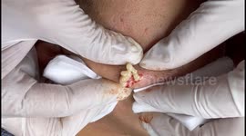 Dermatologist pops giant 5-year-old pimple on man's cheek