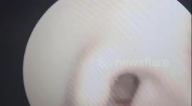Horrifying scene as doctor finds maggots living inside patient's ear