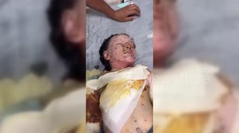 Gaza: Israeli Airstrike Severely Burns Child in Gaza