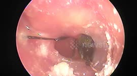 The doctor performed surgery to remove the beetle, which burrowed deep into the woman's ear canal, causing a punctured eardrum