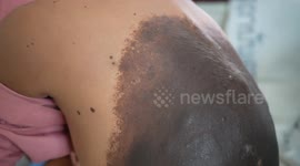Boy, 6, with huge black growth across his body finally receives treatment