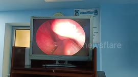 Doctors in northern India successfully remove live leech from man's nose