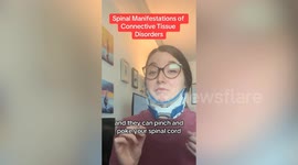 Woman's rare connective tissue disorder was dismissed for anxiety
