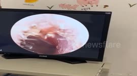 Doctor removes poisonous ant from girl's ear in Vietnam