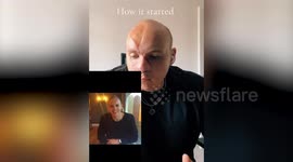 Man has nose rebuilt using ribs after it was ripped off by dog