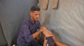 Gaza: Amputees in Gaza face further agony with treatment, prosthetics in short supply