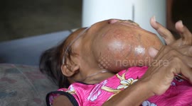 Thai woman's face deformed due to rare cancer 'that started as gum disease'