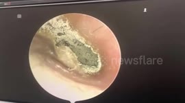 Doctor finds hundreds of tiny mushrooms growing in patient's ear