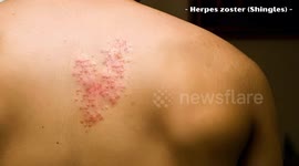 Shingles (Herpes Zoster Infection) - Causes, Signs And Symptoms, Diagnosis, And Treatment
