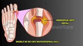 Understanding Gout - Causes, Risk Factors, Signs & Symptoms, Diagnosis & Treatment