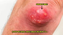 Boils (Furuncles) Unmasked - What You Need to Know |Causes, Signs & Symptoms, Treatment, Prevention