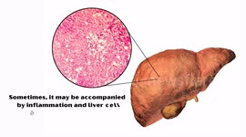 The Ultimate Guide to Understanding Fatty Liver Disease Everything You Should Know About Fatty Liver