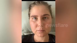 Woman mistook rare cancer for an allergic reaction when her face swelled in size