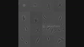 A montage of 16 different Ewing's sarcoma cancer cells entering cell death through necrosis and apoptosis.