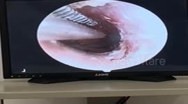 Large cockroach removed from 8-year-old girl's ear