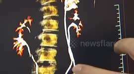 17-year-old girl has four kidneys
