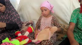 Gazan girl hopes for hair regrowth amid war trauma