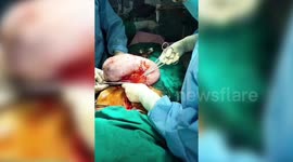 Graphic Content: Doctors remove 15 kg tumor from young woman's stomach in rare surgery in central India