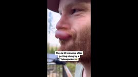 US man documents swelling after being stung on lip by yellow jacket wasp