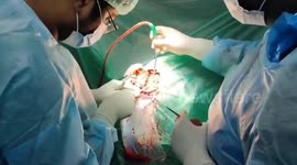 Doctors successfully remove brain tumor while patient watches favorite movie in southern India