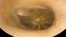 Doctor removes flower from man's ear canal