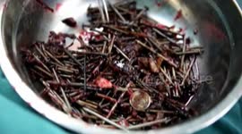 200 nails are taken out from 15-year-old boy's stomach