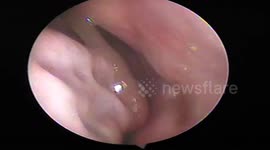 Doctors remove giant live leech from man's nasal passage after he swam in floodwaters