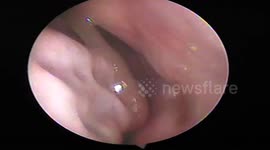 Doctors remove giant live leech from man's nasal passage after he swam in floodwaters