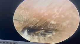 Doctors remove giant cockroach from man's ear canal